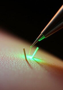 Микроигольчатый РФ-лифтинг: как маленькие иглы возвращают упругость коже